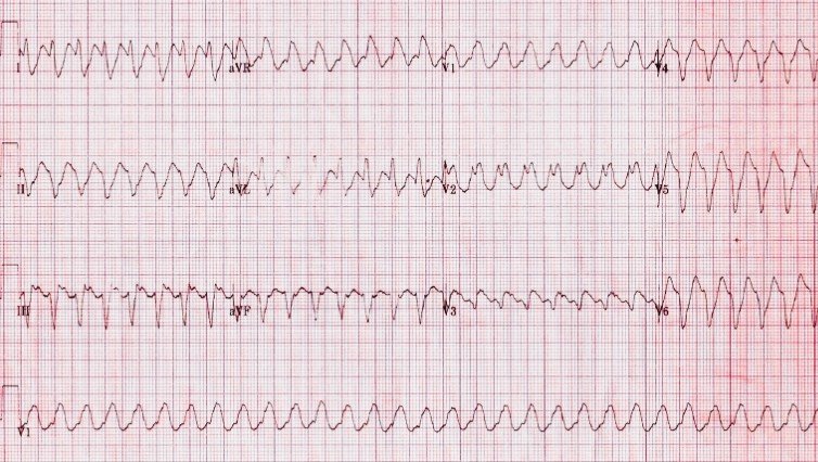 ECG Q: 2