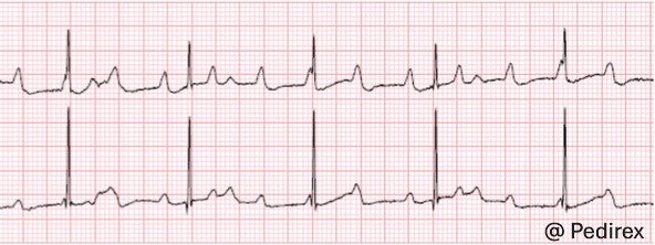 ECG Q: 3
